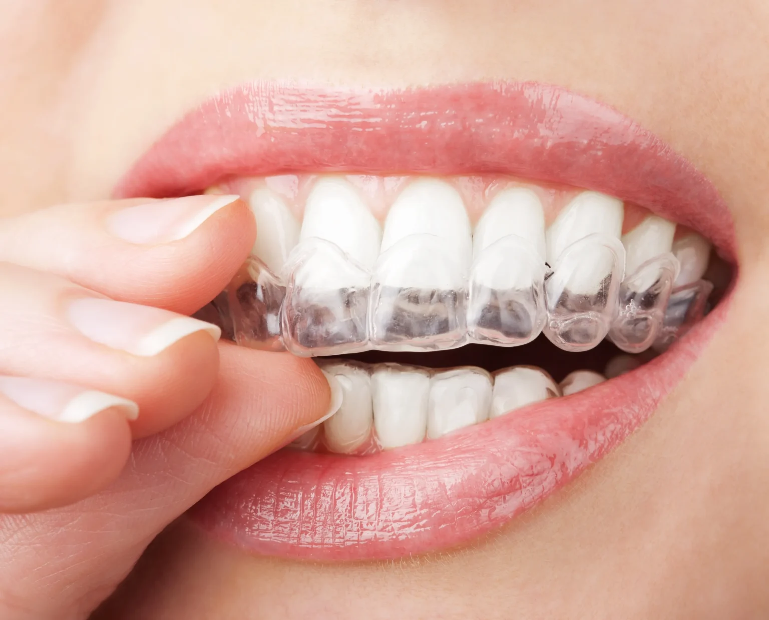 Direct Teeth Whitening, A Smarter Approach to At Home Smile Care